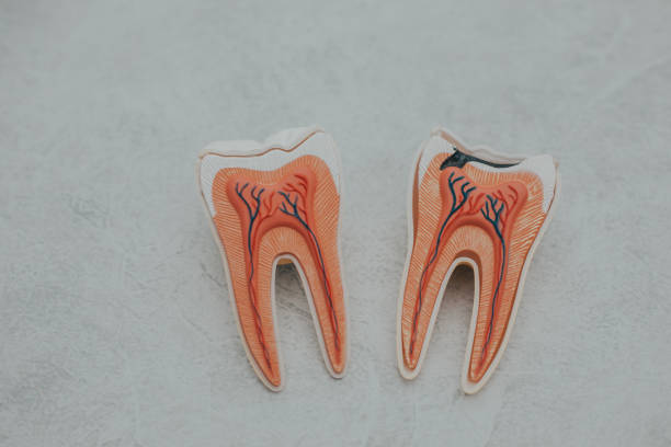1.歯根の細部まで除去するニッケルチタンファイル