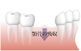 2~3本の欠損の治療方法