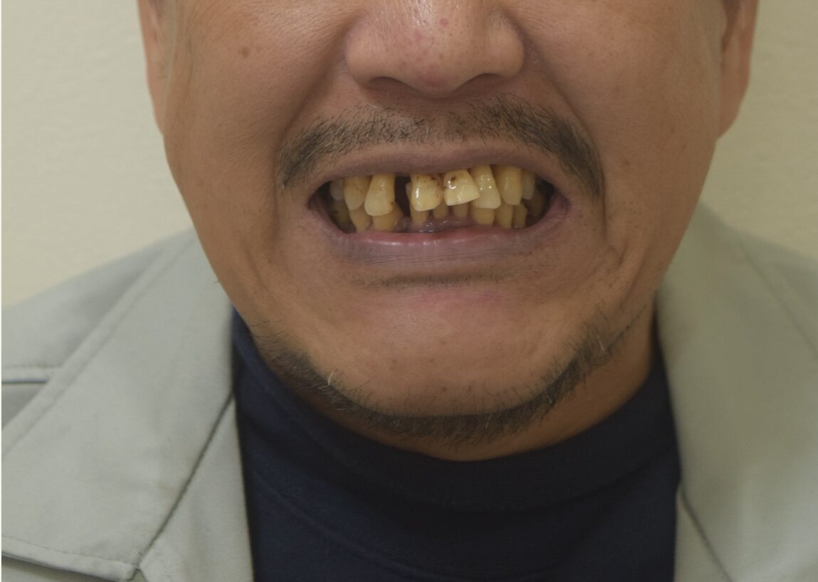 BEFORE