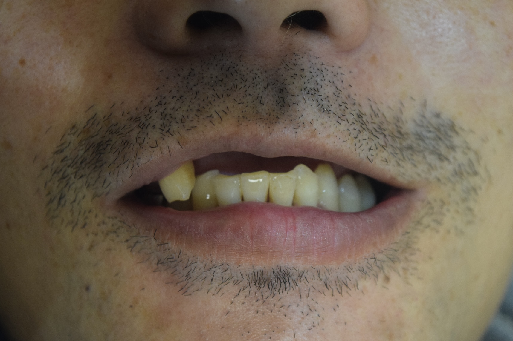 BEFORE