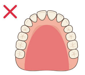 総入れ歯の場合