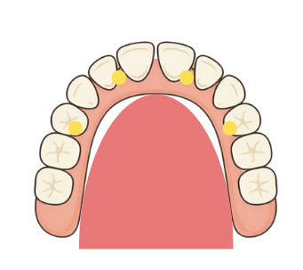 オールオン4の場合