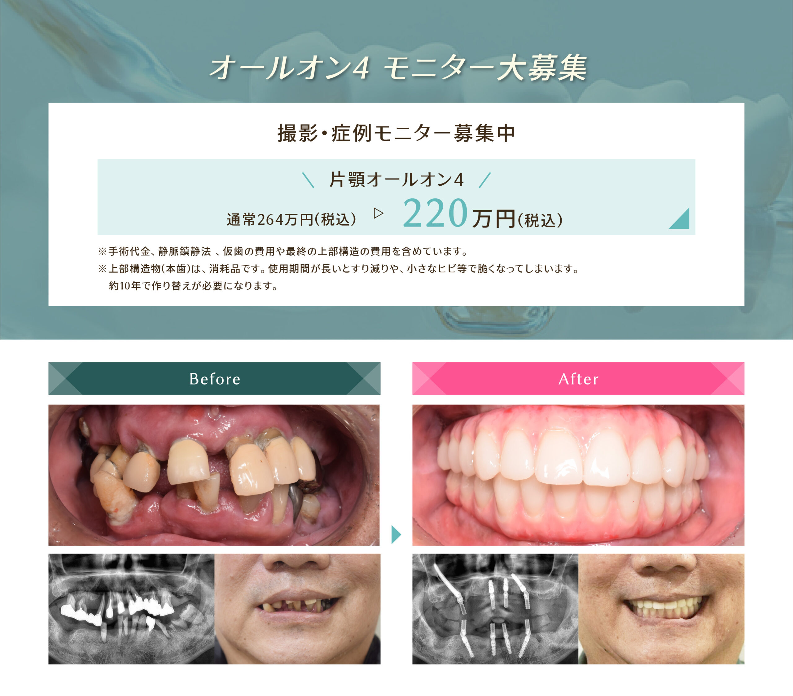 オールオンフォー | 名古屋のインプラント・オールオンフォー専門の医院