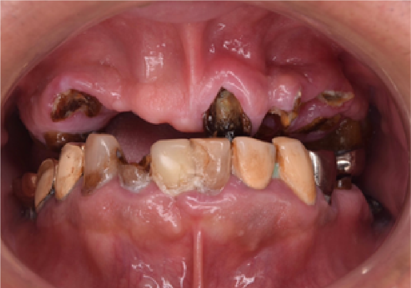 5：こんなに虫歯が多いのに、本当にちゃんと治るのだろうか？